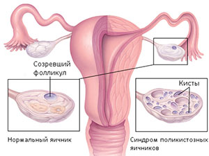 как лечить поликистоз яичников
