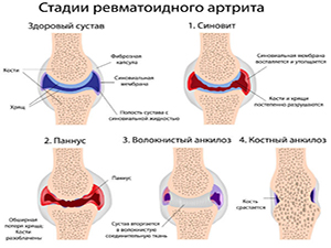ювенильный ревматоидный артрит сопровождение лечения