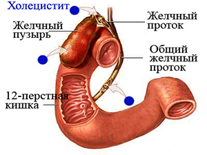  хронический холецистит симптомы и сопровождение лечения