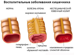 неспецифический язвенный колит сопровождение лечения