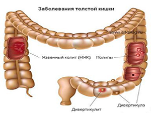 неспецифический язвенный колит кишечника