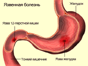 язвенная болезнь желудка симптомы и сопровождение лечения