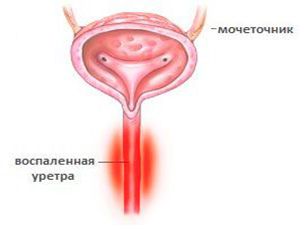 уретрит у мужчин сопровождение лечения